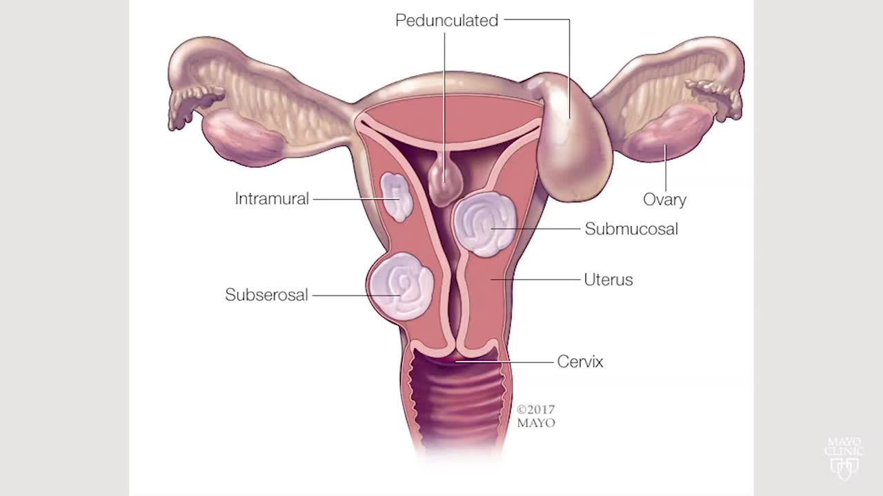 Chảy máu tử cung do rối loạn cơ năng (DUB) - Hình ảnh minh họa